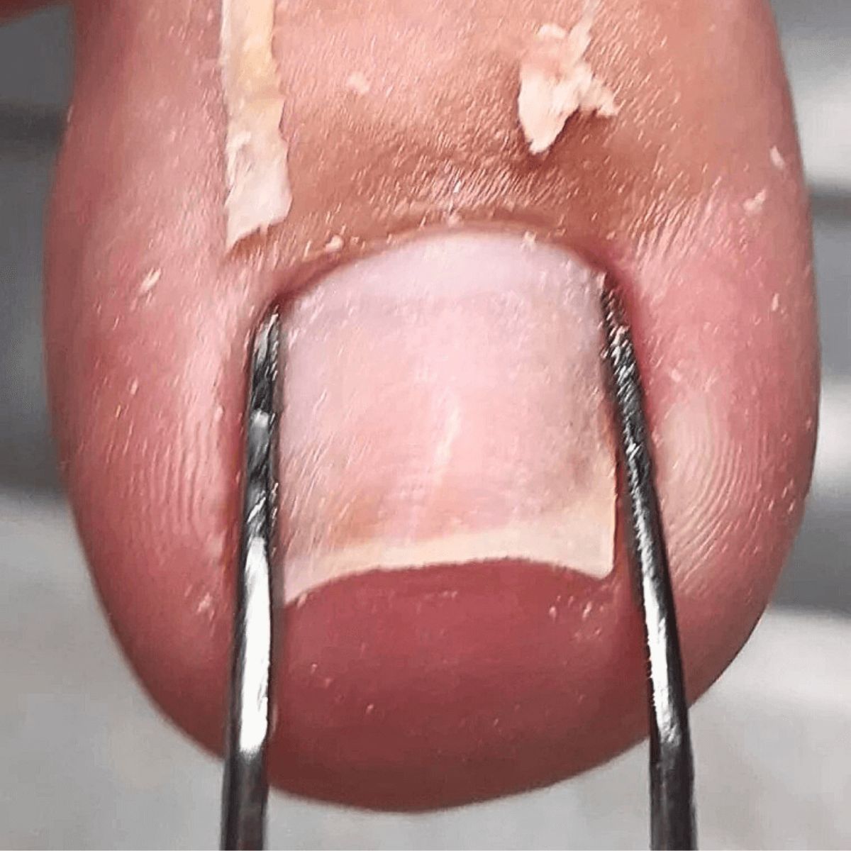 Detalhe de procedimento para desencravar unha com inflamação em Curitiba