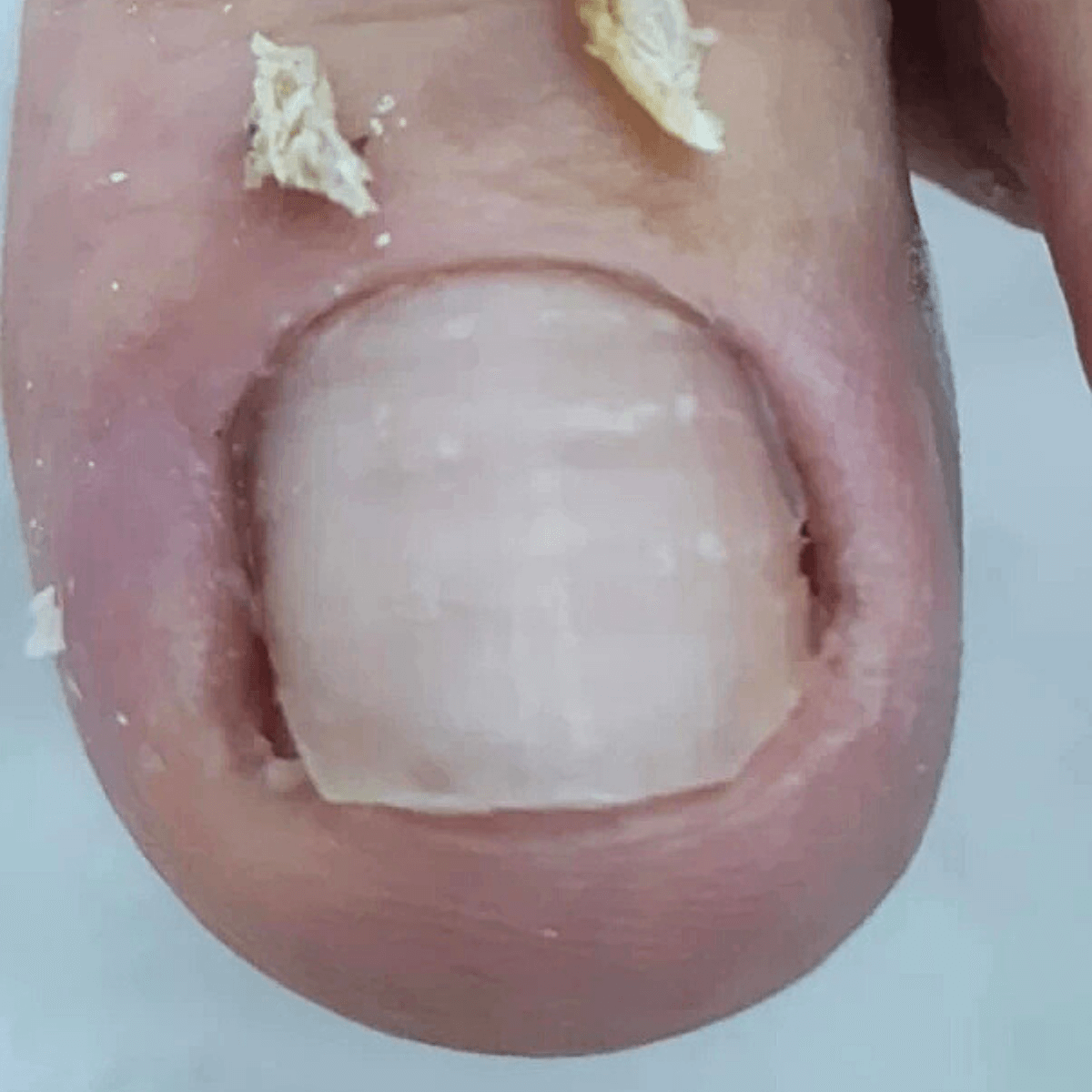 Tratamento corretivo de unha com curvatura acentuada - Podóloga Fátima Barros