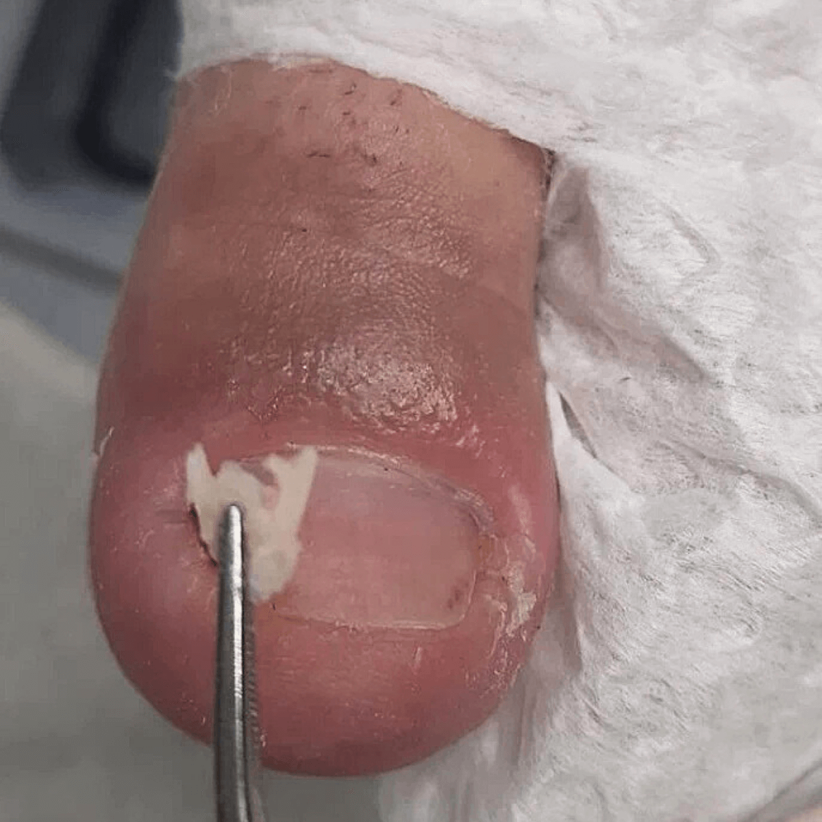 Aplicação de curativo e medicamento em dedo do pé lesionado