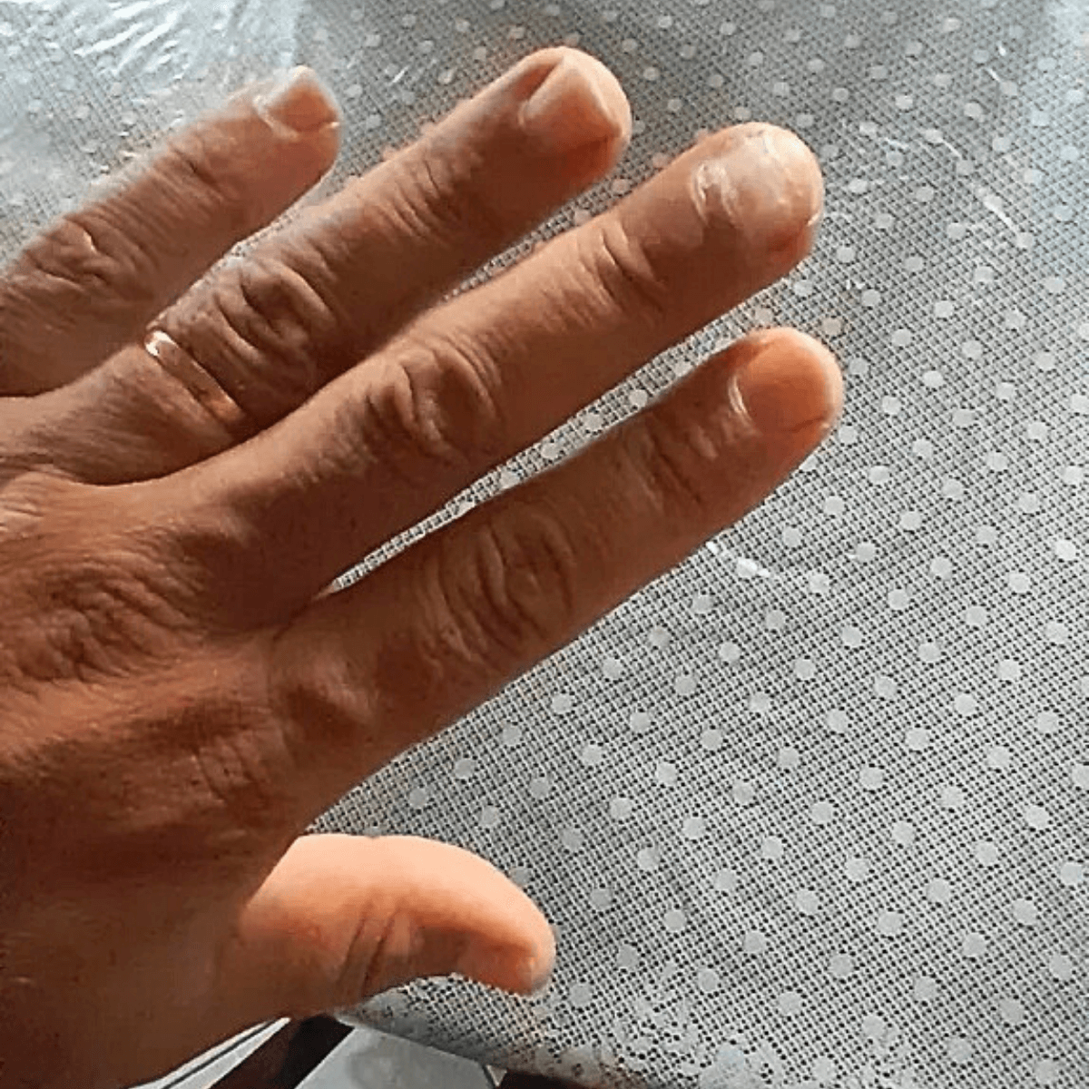 Detalhe de procedimento para desencravar unha com inflamação em Curitiba