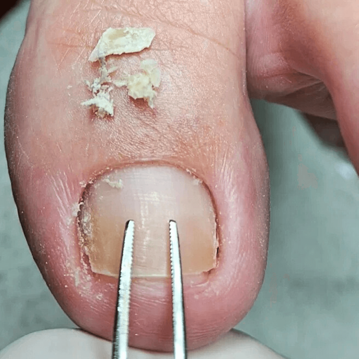 Correção de unha deformada com órtese metálica